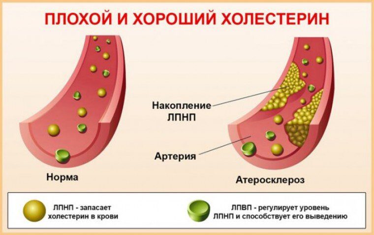 Думаю, большинство читателей знают, что холестерин бывает «хороший» и «плохой».