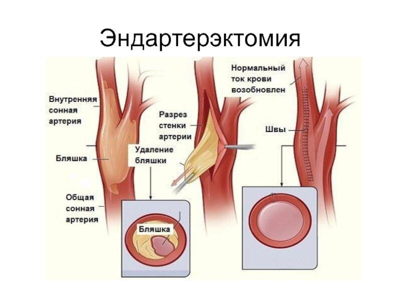 Здесь показано самое типичное расположение бляшки - в месте разветвления общей сонной артерии на наружную и внутреннюю