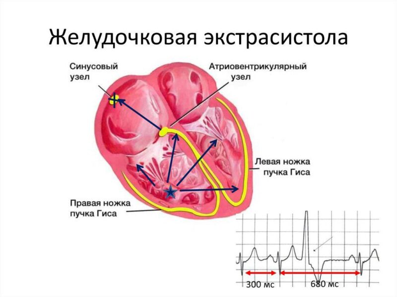 Так выглядит на ЭКГ желудочковая экстрасистола. Звёздочкой показано место её возникновения в миокарде желудочка.