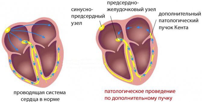 Дополнительный проводящий пучок - это врождённая аномалия, которую легко устранить с помощью РЧА. Но пока он есть, он может вызывать приступы учащённого сердцебиения.