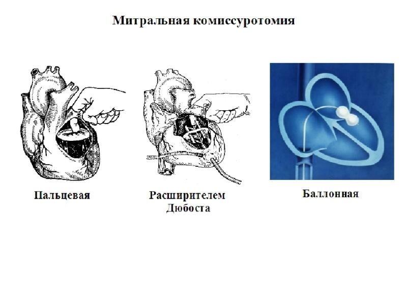 Раньше эту операция проводили просто пальцем (левый рисунок). Сейчас достаточно ввести через вену баллон. Технология усовершенствовалась.
