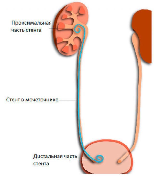 -3