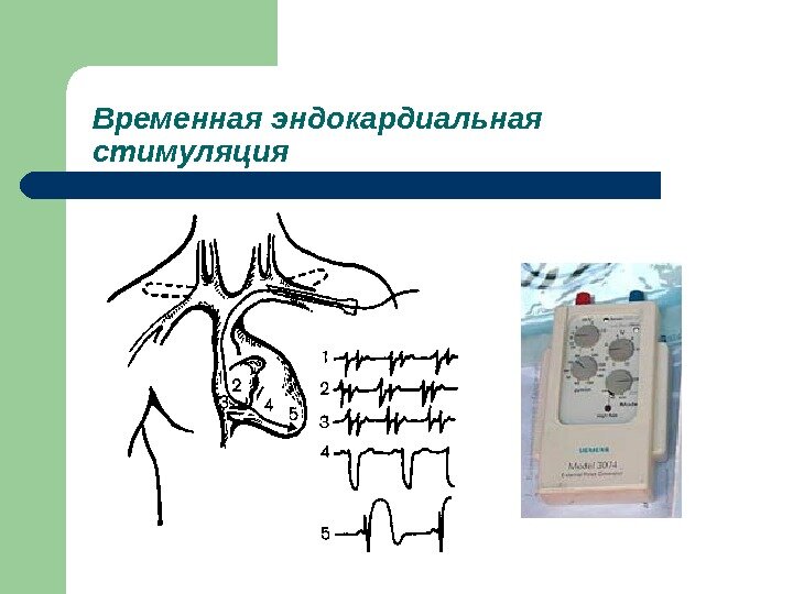 Через левую подключичную вену введён электрод, по которому импульс от стимулятора заставляет сердце сокращаться с нужной частотой. Всё время, пока пациент нуждается во временном стимуляторе, электроды и сам прибор находятся снаружи.