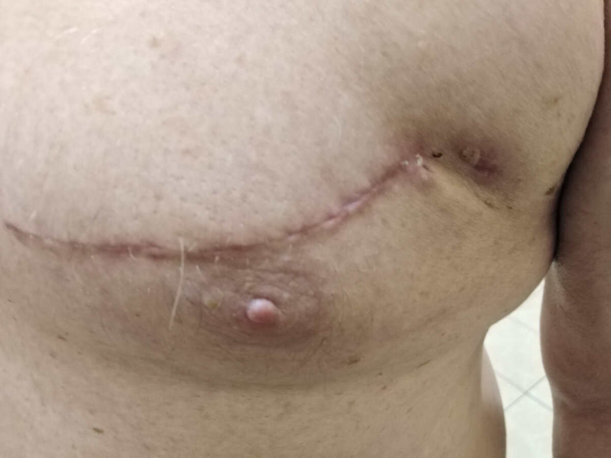 Такой послеоперационный рубец остался у пациента. Не сравнить с рубцом на грудине.