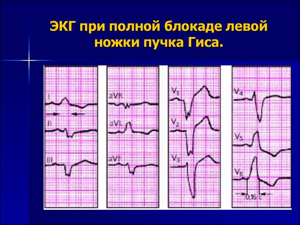 Здесь мы видим деформированные комплексы, которые затрудняют диагностику ишемических изменений. 