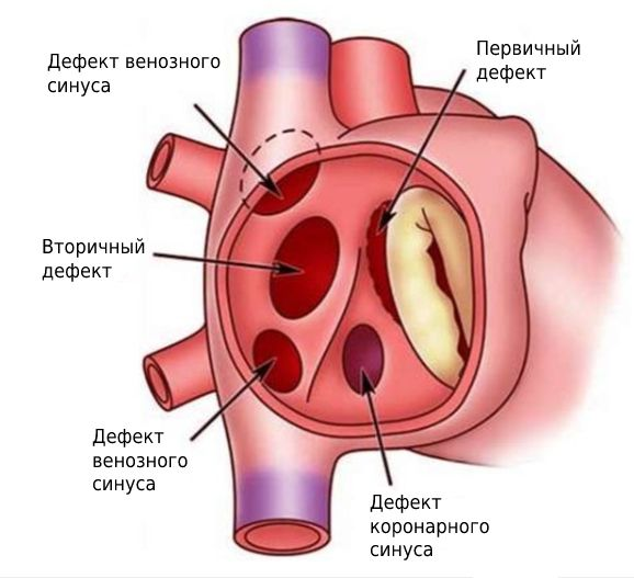 Вторичный дефект межпредсердной перегородки возникает из-за недоразвития вторичной перегородки у эмбриона. Находится в центре пергородки в отличие от первичного дефекта (он вызван недоразвитием первичной перегородки у эмбриона, поэтому так и называется). Оба заболевания относятся к врождённым порокам сердца.
