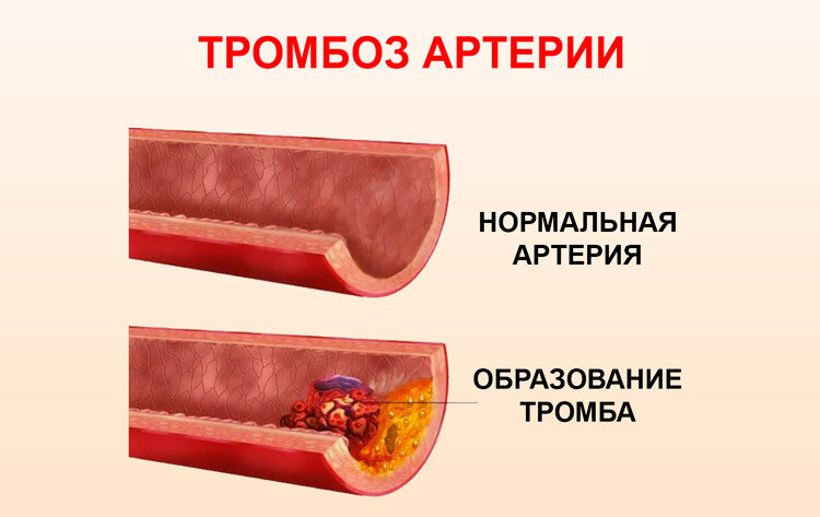 В месте образования бляшки скорость кровотока наибольшая. Это увеличивает риск тромбообразования. Закрывая просвет сосуда, этот тромб приносит наибольший вред в том месте, где образовался.