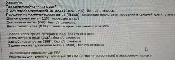 Окклюзия диагнональной ветви в проксимальной трети. Если стент не поставить вовремя, объём поражения мышцы будет очень большой.